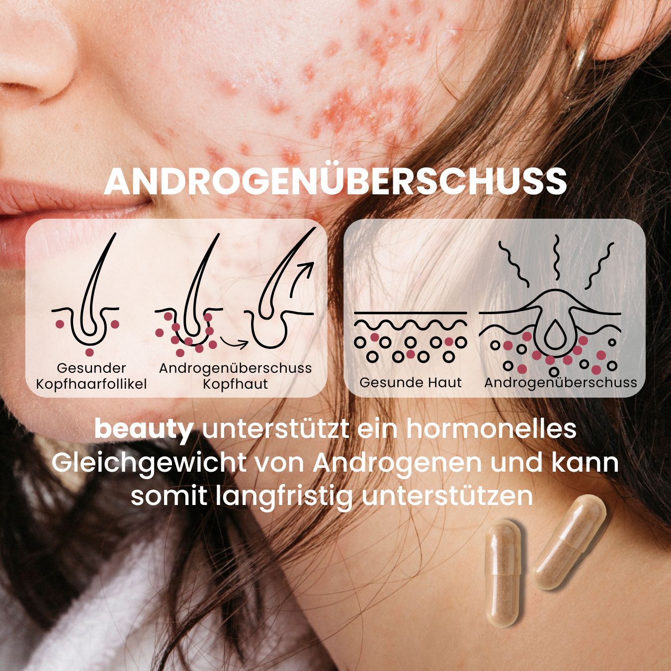 Androgenüberschuss fenou beauty