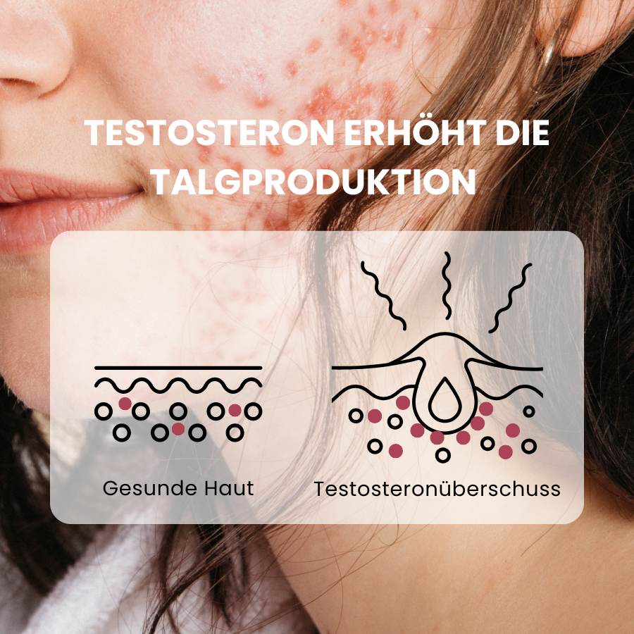 Wirkungsweise von Androgenüberschuss an Talgdrüsen, hormonelle Akne