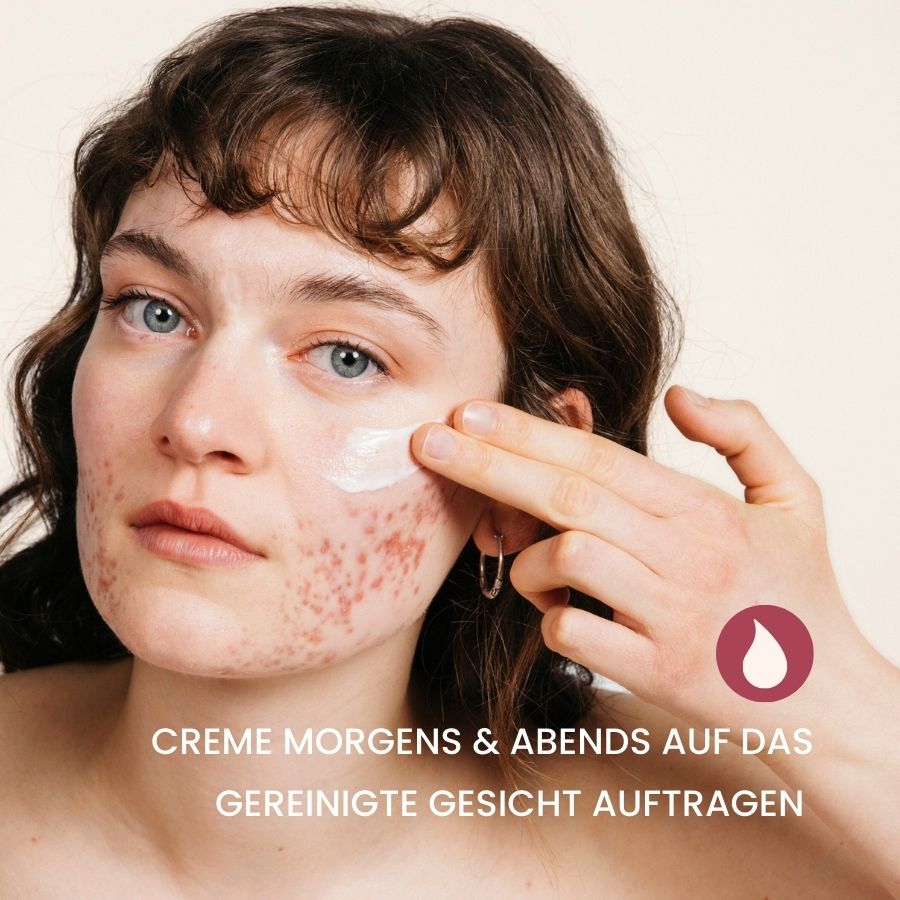 weiblich gelesenes Modell mit Akne cremt sich das Gesicht mit fenou clear skin ein