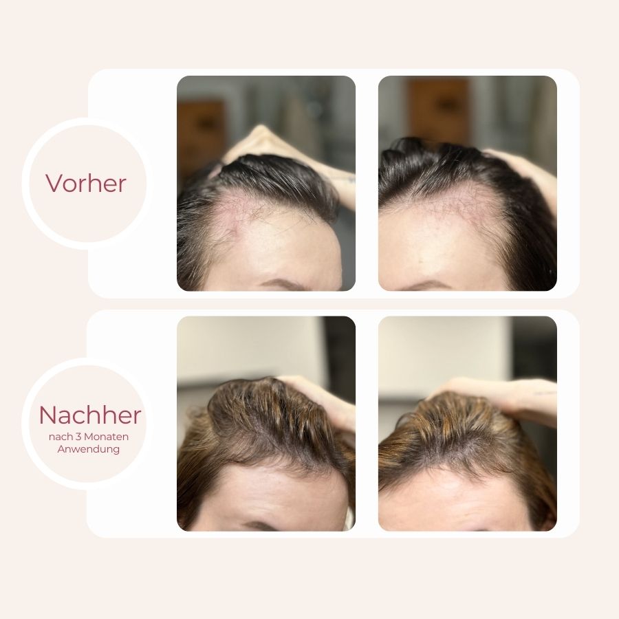 Vorher-Nachher Bilder Anwendung grow Haarserum, Haarausfall bei Frauen, Mittel gegen Haarausfall