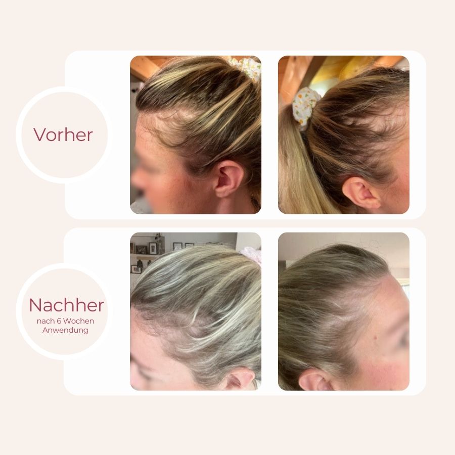 Vorher-Nachher-Bilder Anwendung grow Haarserum, Haarausfall bei Frauen, Mittel gegen Haarausfall