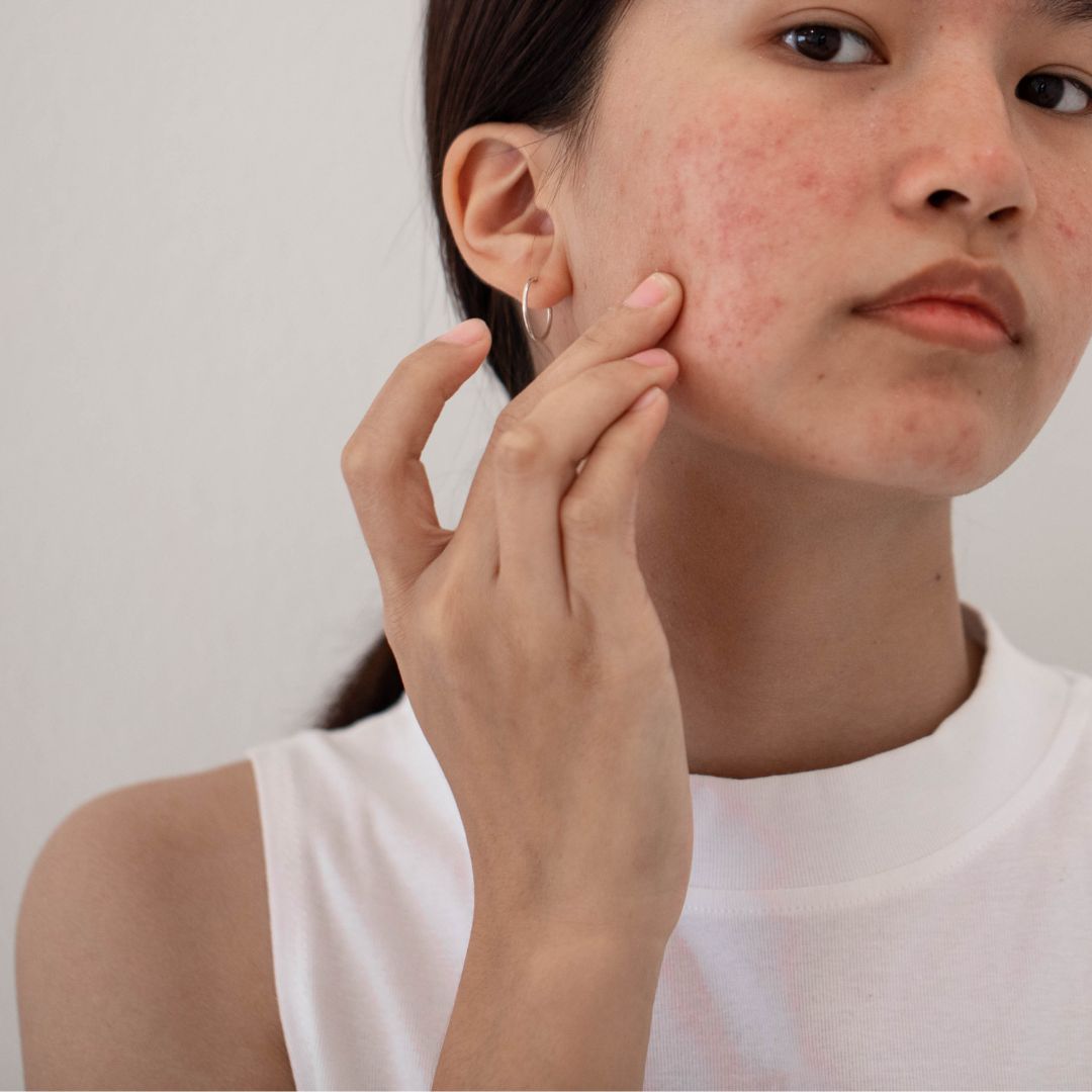 gesicht hautprobleme akne