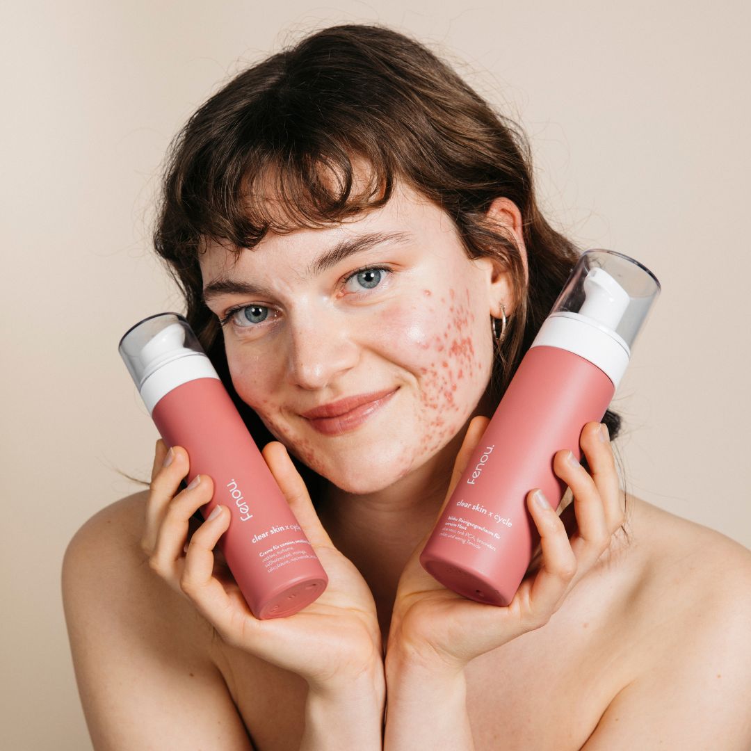 Model mit Akne hält clear skin Creme und Foamer neben ihr Gesicht