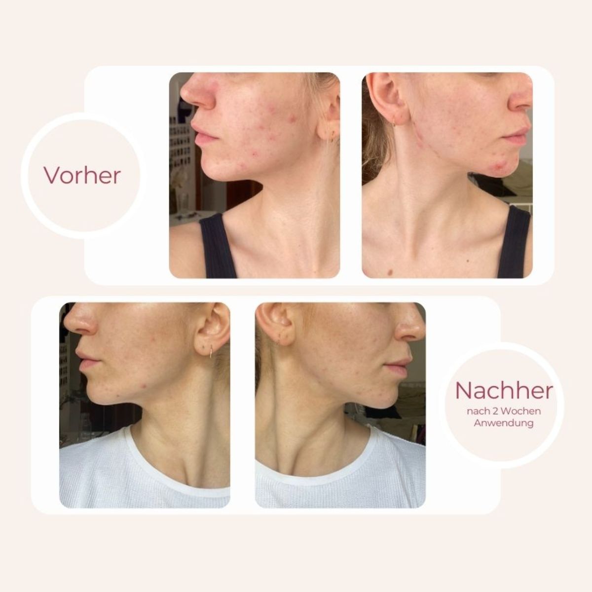 Vorher-Nachher Bild von Akne an Kinn nach benutzung von fenou clear skin Aknecreme