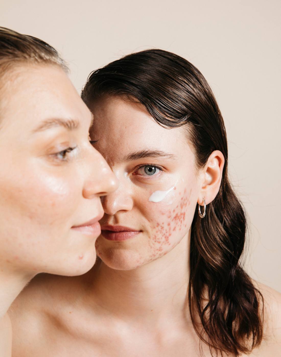 porträt zweier weiblich gelesener modells mit akne, ein Gesicht seitlich angeschnitten, das andere modell schaut in die kamera. Auf der Wange ist creme aufgetragen.